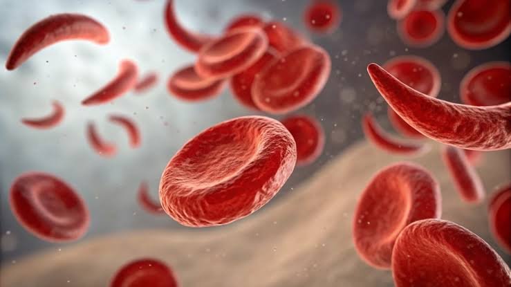 Africa Urged to Act Now as Thousands of Children Die from Sickle Cell Disease